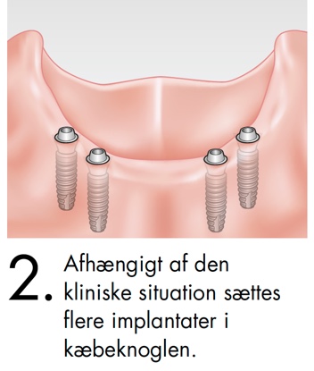 Afhængigt af den kliniske situaton sættes flere implantater i kæbeknoglen