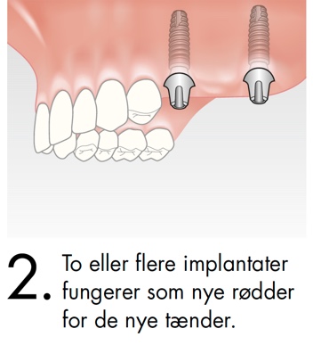 To eller flere implantater fungerer som nye rødder for de nye tænder