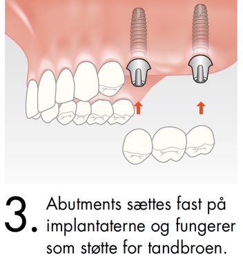 Abutments sættes fast på implantaterne og fungerer som støte for tandbroen
